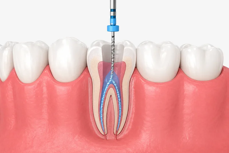 Endodoncia