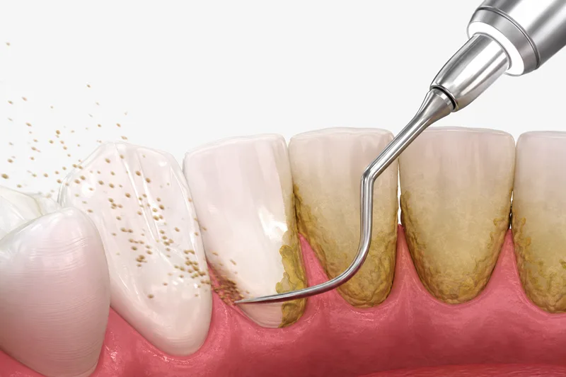 Limpieza dental